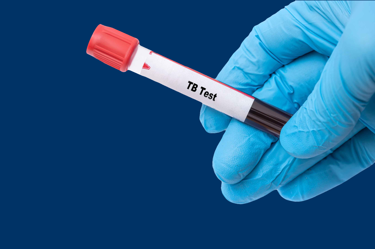 Why you owe it to yourself to get a TB test
